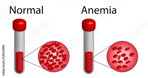 Iron deficiency anemia. The difference of Anemia amount of red blood cell and normal. Realistic vector 3d picture. Vector illustration isolated on white background