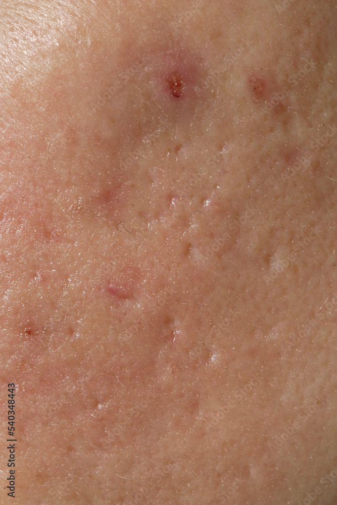 Fototapeta premium Extreme close-up of texture of problematic human skin with large-looking open pores and acne scars