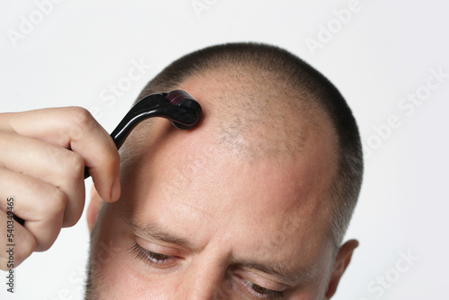Men using microneedle derma roller on head for stimulating new hair growth. Simple and cheap treatment for alopecia.