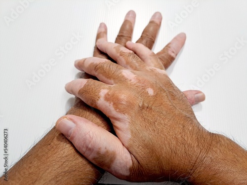 vitiligo on hands isolated on white background
