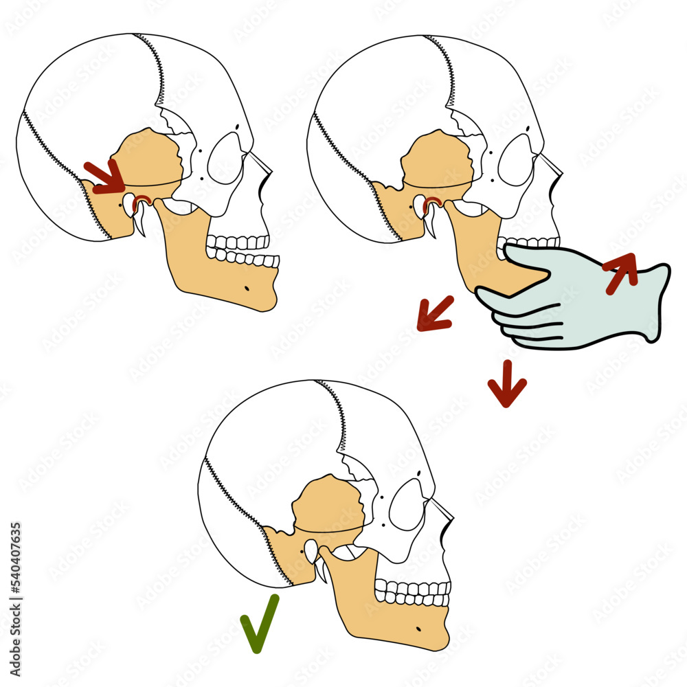 Reduction of the temporomandibular joint. Vector illustration Reduction of the temporomandibular joint. Vector illustration