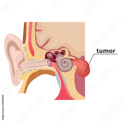 vestibular schwannoma. Diagram with a tumor in the inner ear. Vector illustration