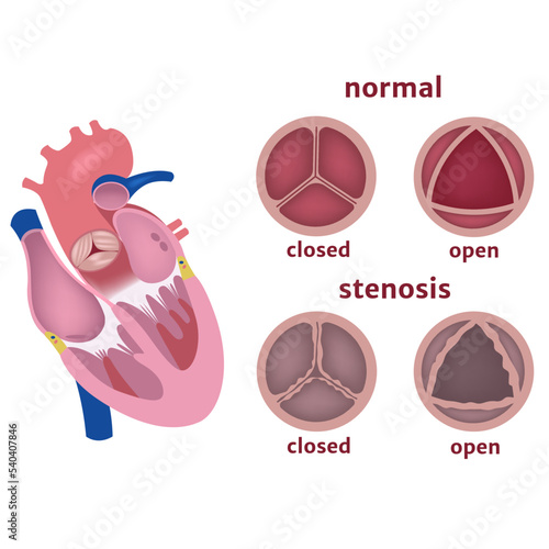 Stenosis of the aortic valve of the heart. Disease infographic. Vector illustration photo