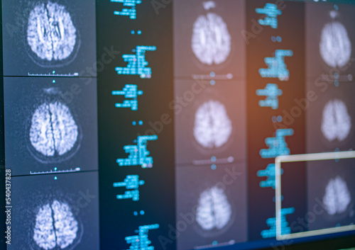 MRI brain , DWI ( Diffusion weighter image ) technique for detect stroke. photo