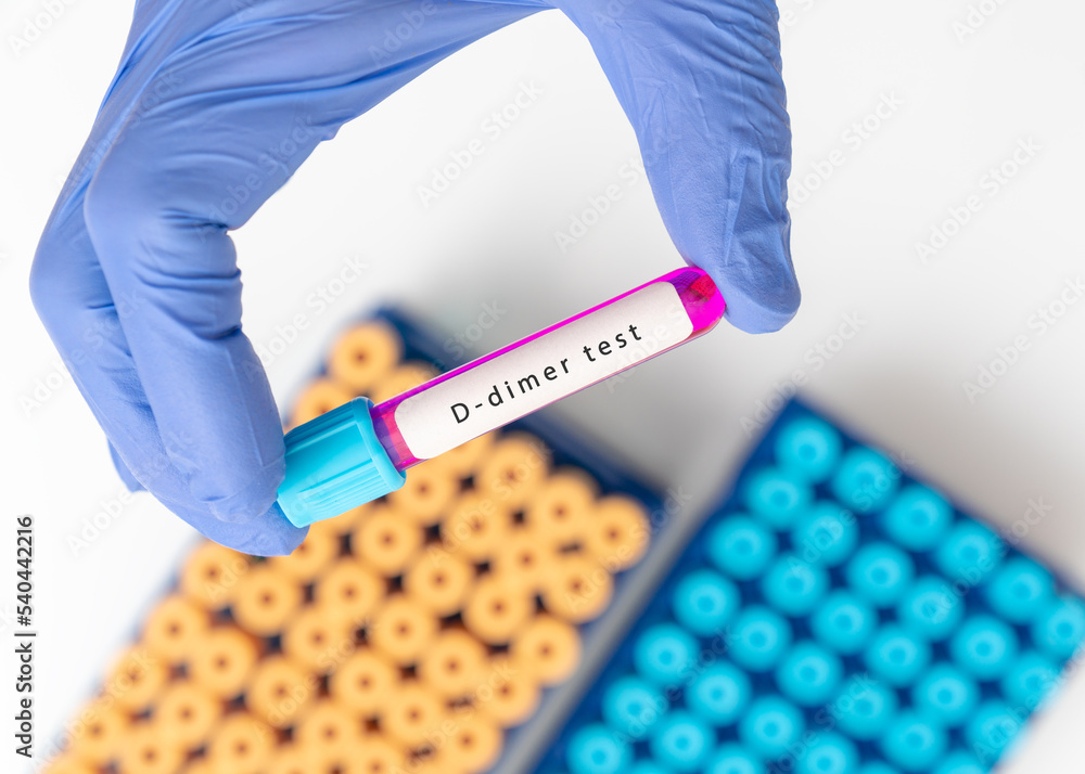 Blood sample test tube for Ddimer test, diagnosis for intravascular