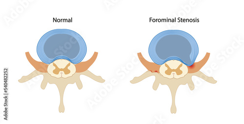 Forominal stenosis lumbar illustration. Nerve root compressed.  photo