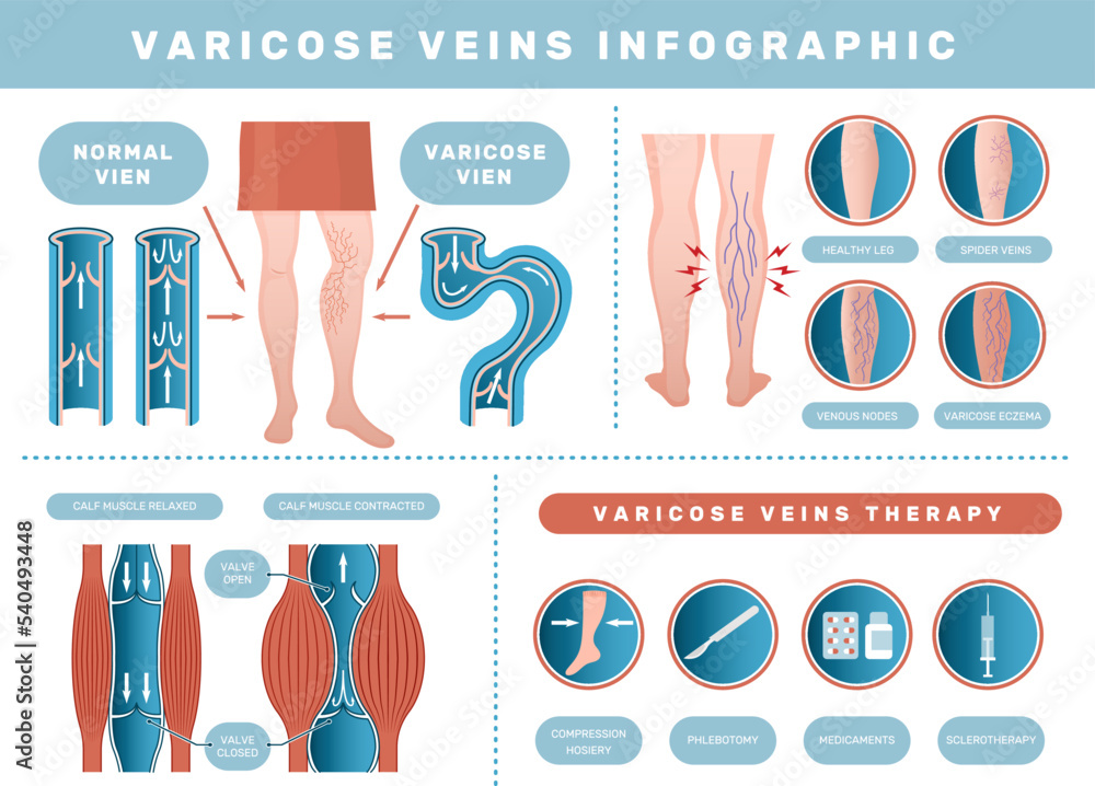 Varicose infographic. Venous disease medical health problems with human blood venous recent vector template set