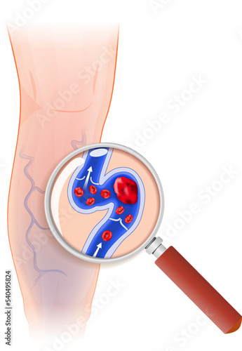 Cross section of varicose vein through a magnifying glass
