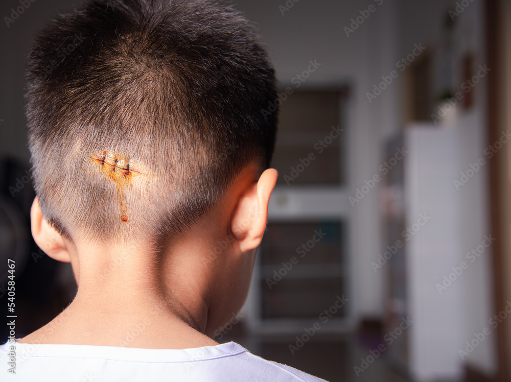 The lacerated sutured wound of kid back head which suture by nylon