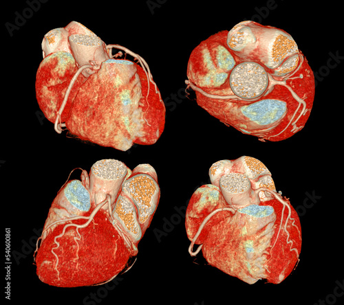 Foto CT Cardiac 3D or CTA coronary artery for prevention and screening coronary artery diseases
