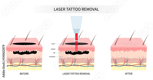 skin tattoo remove surgery