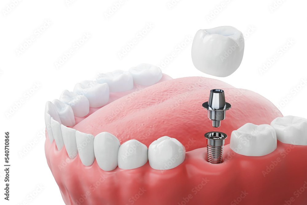 Dental implantation, teeth with implant screw, 3d illustration. - obrazy, fototapety, plakaty 