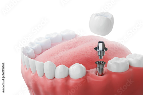 Dental implantation, teeth with implant screw, 3d illustration. photo