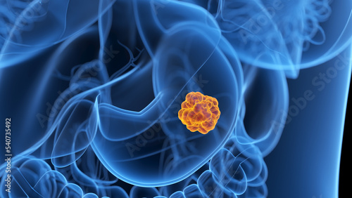cancer illustration