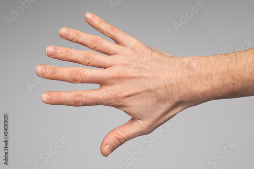 Case of polidactyly. Hand of man with hexadactyly