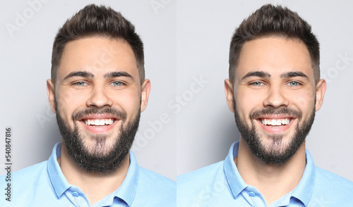 Double chin problem. Collage with photos of man before and after plastic surgery procedure on light grey background