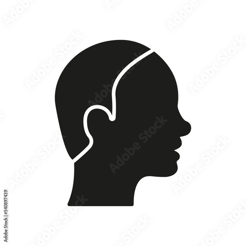 Bald Male Silhouette Icon. Hairless Man Black Pictogram. Alopecia Medical Problem Icon. Isolated Vector Illustration
