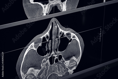 computed tomography (CT) scan of the nasal septum, skull bones