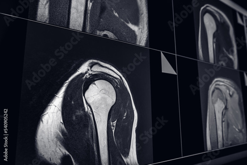 MRI Scan, Magnetic Resonance Images of the shoulder joint