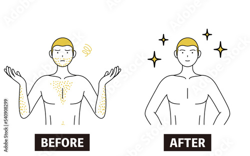 医療脱毛のイメージ、体毛が濃くて悩んでいる男性が脱毛して自信満々になるビフォーアフター