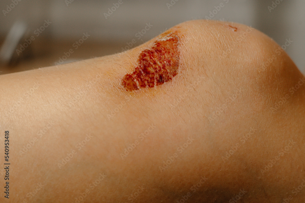Fototapeta premium Infected wound on the knee close up, healing process, woman holding her leg with her hands