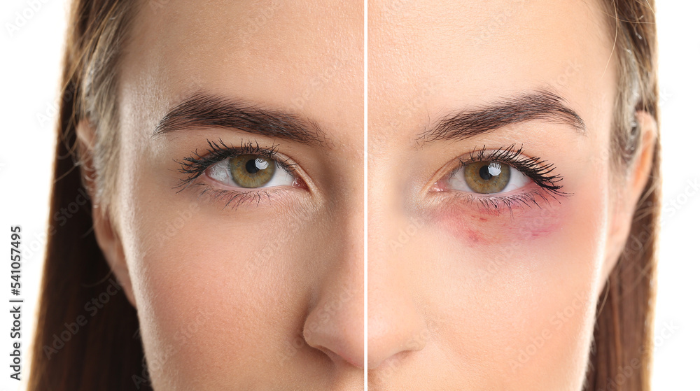 Fototapeta premium Face of young woman with and without bruise under eye on white background, closeup