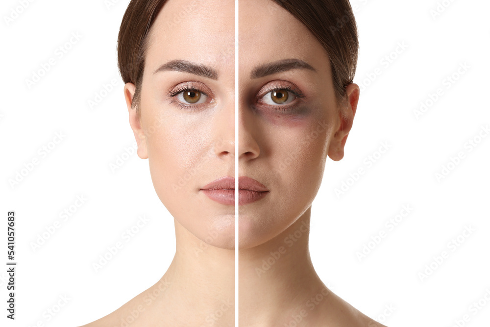 Ταπετσαρία Face of young woman with and without bruise under eye on white background