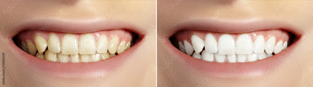 Woman Teeth Before and After Whitening. Perfect Smile with Healthy Teeth. Dental Clinic Patient. Oral Care Dentistry
