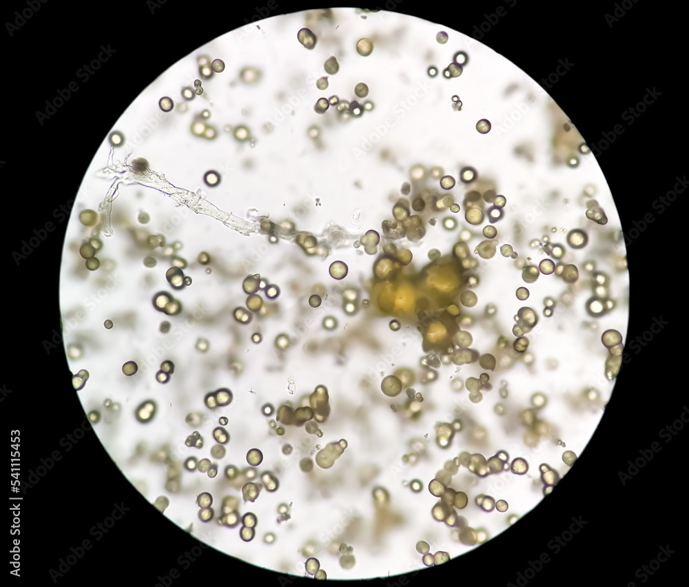 Microscopic image of Urinalysis. Abnormal urine exam. Uric acid