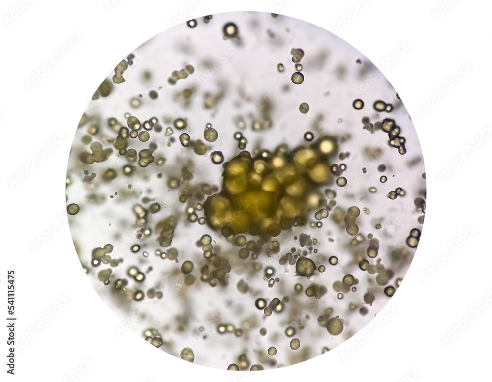 Microscopic image of Urinalysis. Abnormal urine exam. Uric acid crystals. Microscopic image of Urinalysis. Abnormal urine exam. Uric acid crystals.