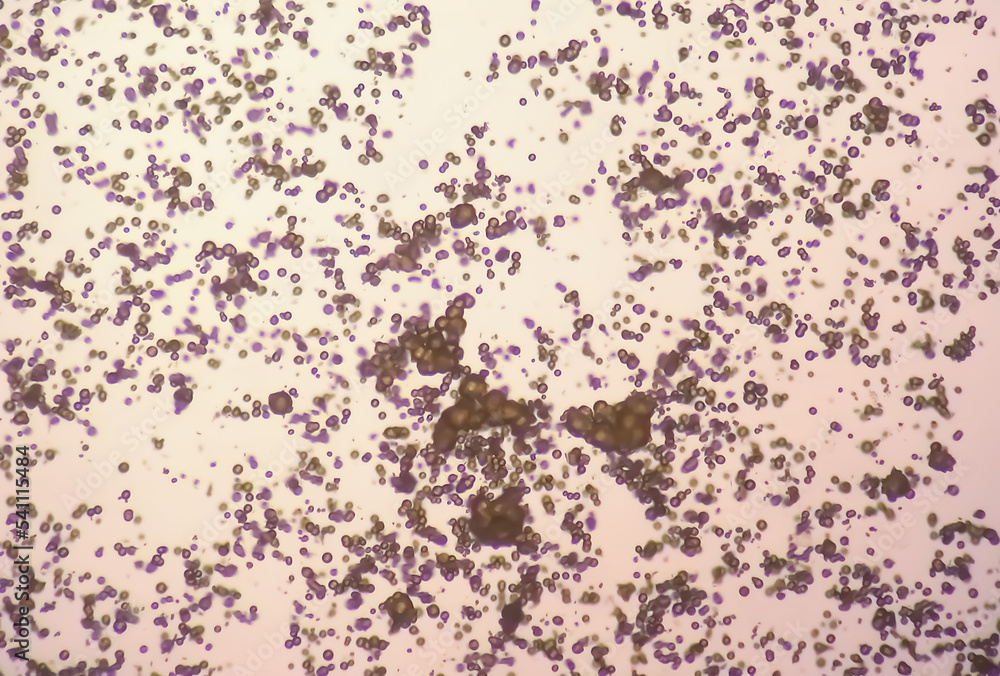 Microscopic image of Urinalysis. Abnormal urine exam. Uric acid crystals. Microscopic image of Urinalysis. Abnormal urine exam. Uric acid crystals.
