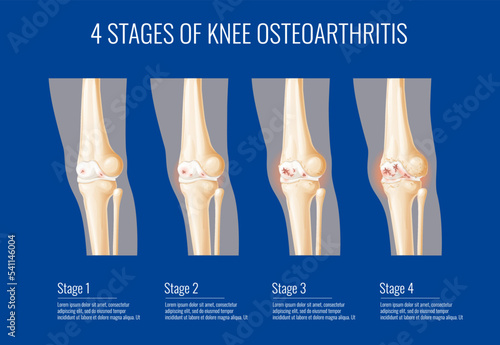 Knee joint osteoarthritis stages, medical infographics on bone cartilage arthritis, vector legs health. Knee joint osteoarthritis disease symptoms, information on knee cartilage inflammation