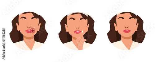 A set of icons with girls applying cream to the corner of their lips. Inflammation. Stomatitis. Vector Stock illustration. White background. isolated