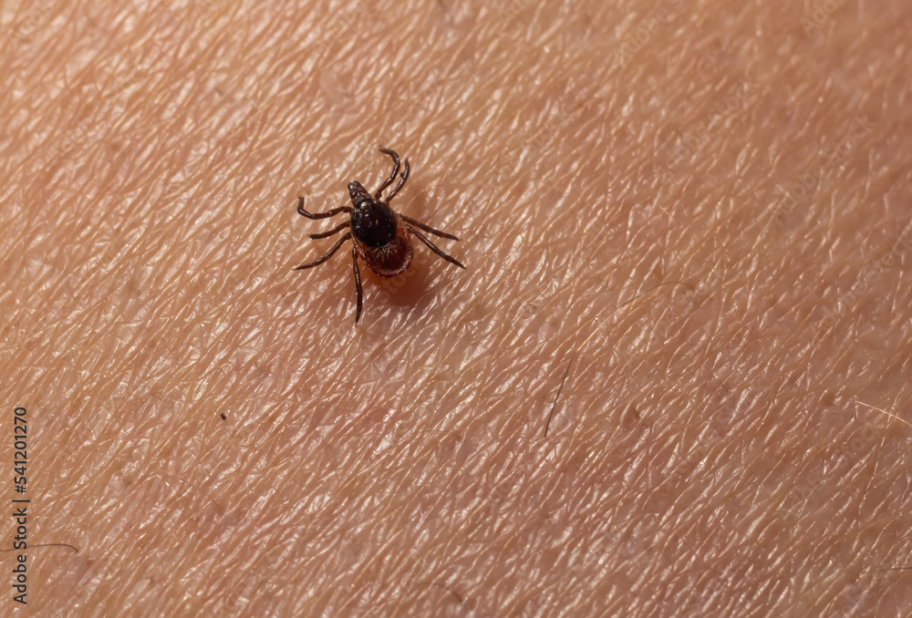 Infected Female Deer Tick On Hairy Human Skin. Ixodes Ricinus 