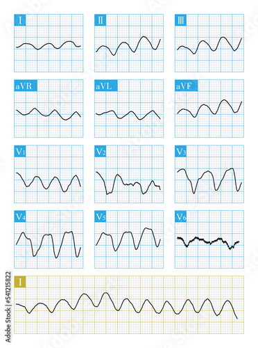 Ventricular flutter is a fatal fast ventricular arrhythmia. The ECG wave is sine wave, difficult to distinguish QRS wave and T wave, and easy to degenerate into ventricular fibrillation.