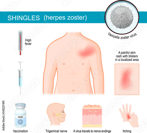 Shingles. infographics about symptoms of herpes zoster.