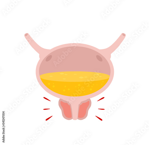 Inflammation of prostate. Scheme of health and bladder problems. Yellow urine. Concept of prostatitis. Flat cartoon