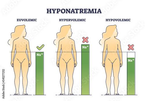 Hyponatremia body condition with low sodium salt level outline diagram. Labeled educational medical disease comparison with Na below or above normal vector illustration. Euvolemic and hypovolemic.