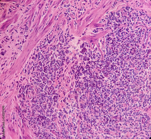 Anal canal ulcer biopsy: Chronic nonspecific proctitis, show anal mucosa, dense infiltration of lymphocytes, histiocytes and plasma cell in lamina propria with area of ulceration. photo