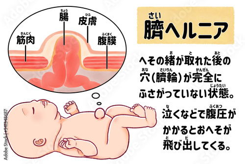 赤ちゃんの臍ヘルニア 日本語の図解イラスト