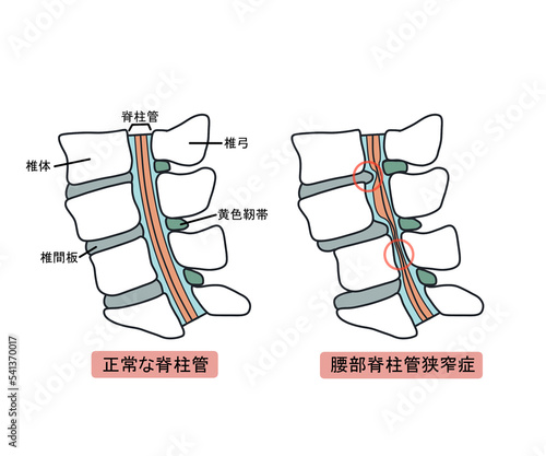 Cuadro en lienzo 腰部脊柱管狭窄症