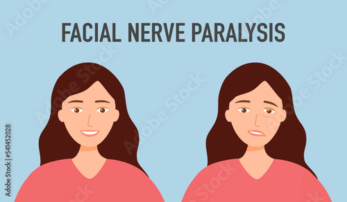 Facial nerve paralysis concept vector illustration. Face palsy.