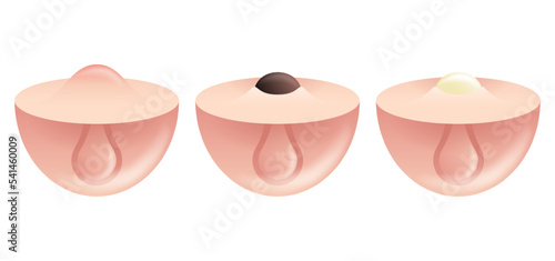 Types of acne pimples, blackhead, whitehead