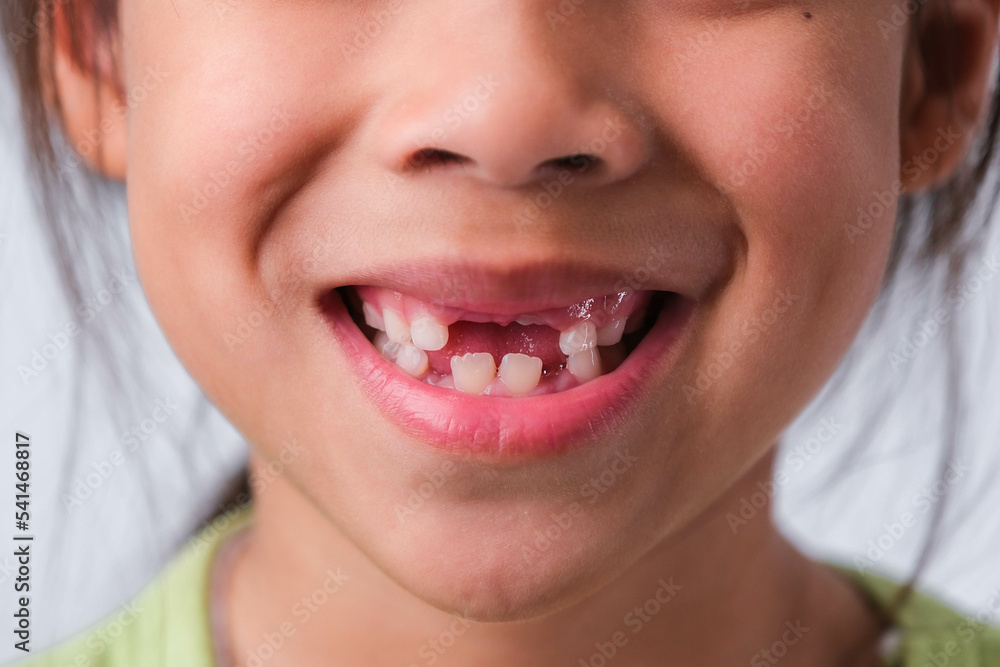 Close-up of a girl with broken upper baby teeth and first permanent teeth. Friendly little girl showing her broken teeth isolated on white background. Close-up of a girl with broken upper baby teeth and first permanent teeth. Friendly little girl showing her broken teeth isolated on white background.