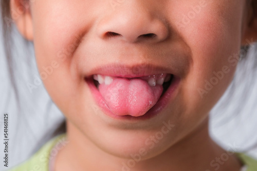 Close-up of a girl with broken upper baby teeth and first permanent teeth. Friendly little girl showing her broken teeth isolated on white background.