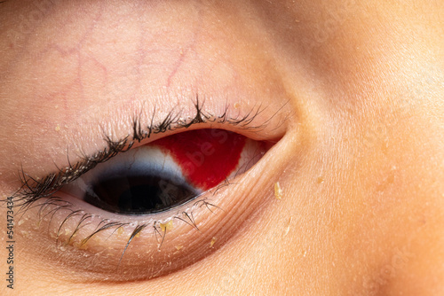 Subconjunctival hemorrhage, macro of blood in a child's red eye photo