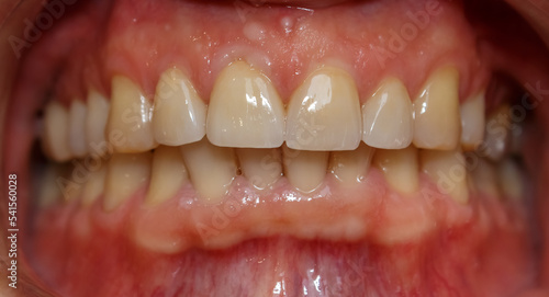 Human frontal teeth prosthetics with ceramic veneers of natural color. Aesthetic dentistry. Dental prosthetics with veneers and crowns. Restoration of teeth.