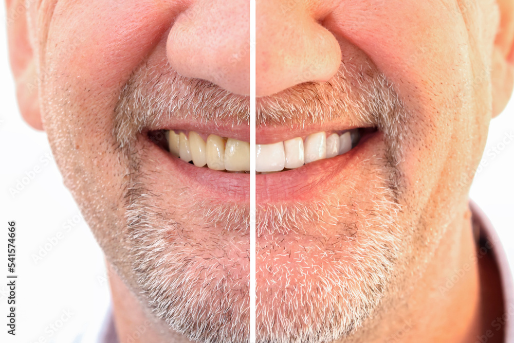 Obraz premium Closeup smiling caucasian man Teeth comparison Before and After teeth whitening treatment from yellow to be white teeth. Dental health and oral care in adult Concept. 