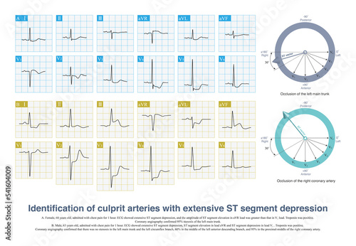 Εκτύπωση καμβά When extensive ST segment depression occurs, the most important differential diagnosis of ECG is to deduce left main artery occlusion or single coronary artery occlusion