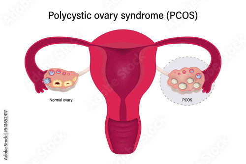 Polycystic ovary syndrome PCOS. Multiple immature follicles vector. Ovarian cysts with female reproductive system. photo